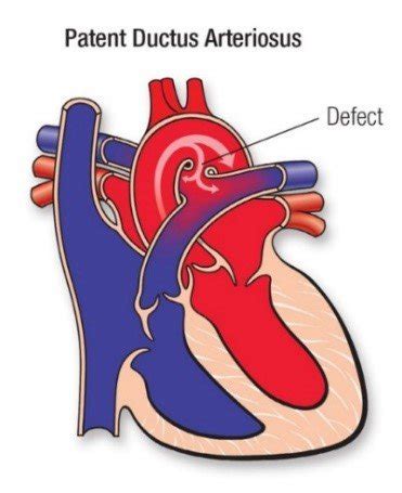 Arterial Ligation Surgery Vinmec