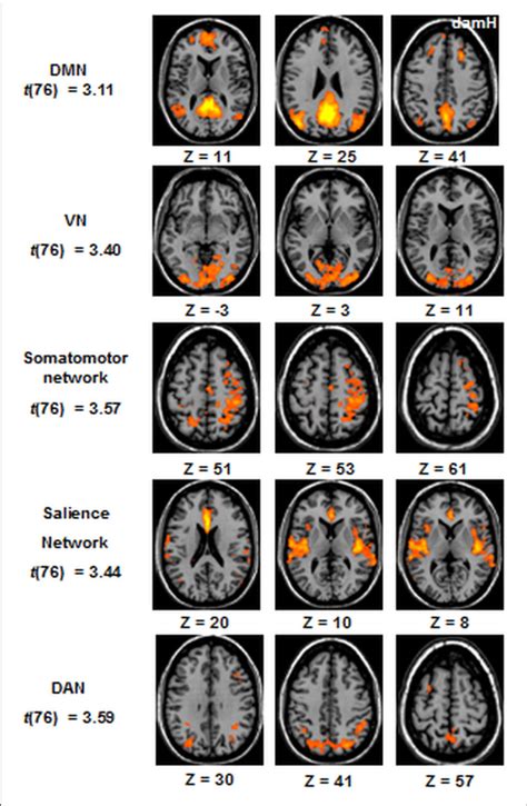 ICA Resting State Networks At The Whole Group Level Statistical Maps