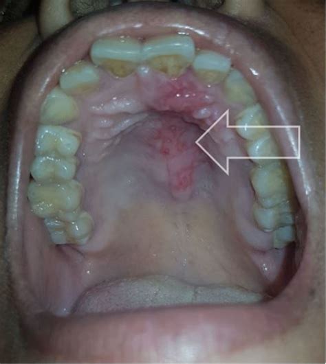 Canker Sore On Soft Palate