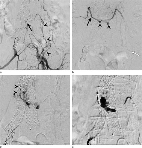 Double Coaxial Microcatheter Technique For Transarterial Aneurysm Sac