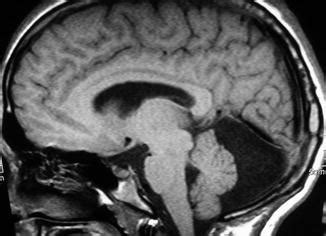 Arachnoid Cysts of the Posterior Fossa | Neupsy Key