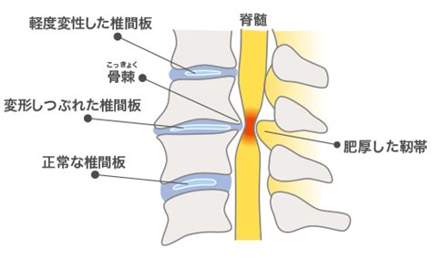 頚椎症性脊髄症 岐阜市 松岡整形外科・内科 リハビリテーション