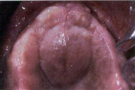 PPTX CISTOS Odontogênicos e Não Odontogênicos DOKUMEN TIPS