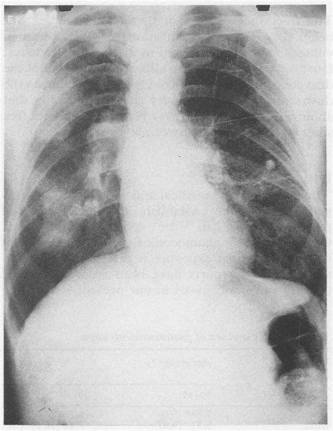 Progressive Massive Fibrosis With Egg Shell Calcification Of Hilar Glands Download Scientific