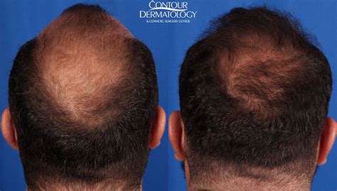 Neograft Hair Restoration To Many A Full Head Of Hair Represents