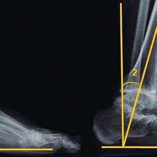 Method for radiographic measurement of ankle range of motion. In figure ...