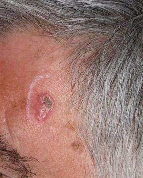 La Incidencia Del Cáncer De Piel No Melanoma Es El Doble En Los Pacientes Con Vih