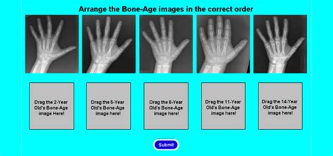 Using X-Rays To Evaluate Growth - Cincinnati Children's Blog