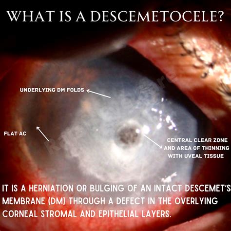 Weekend Bytes What Is A Descemetocele