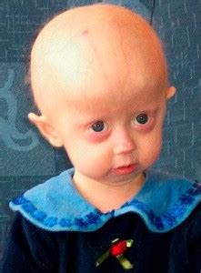 Progeria, the rare genetic disease – Finesse Corner