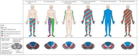 Qué es la lesión medular Cómo se clasifica centro activa