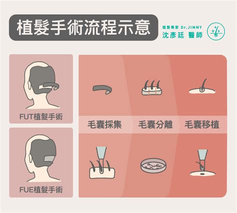 植髮流程懶人包｜3分鐘帶您了解植髮5步驟及相關風險 台南植髮：台南植髮醫師推薦 沈彥廷醫師