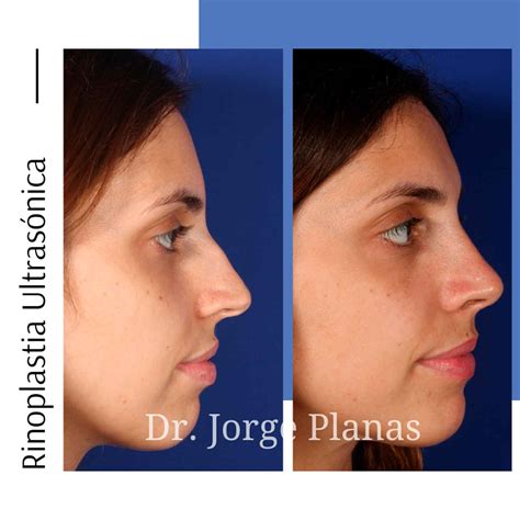 Rinoplastia Ultras Nica Antes Y Despu S Resultados Espectaculares