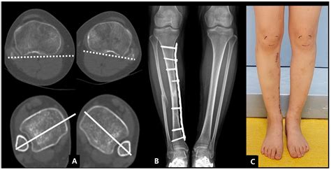 Jcm Free Full Text Minimally Invasive Derotational Osteotomy Of