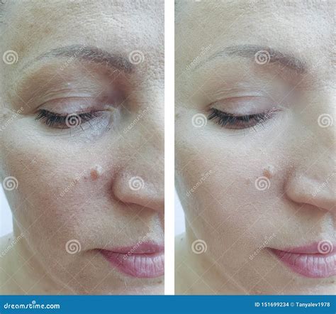 Woman Face Wrinkles Before And After Mature Treatment Correction