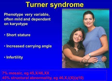 Turner Syndrome