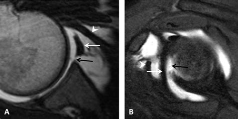 Glenohumeral Ligament Mri