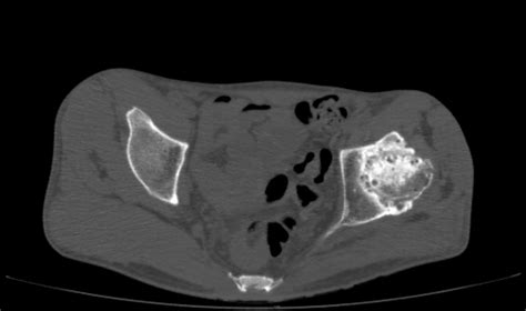 Avascular Necrosis Of The Left Hip Image