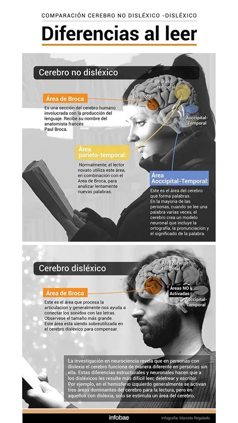 ¿qué Ocurre En El Cerebro Cuando Tenemos Dislexia Infobae