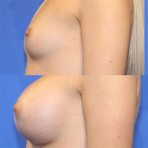 Breast Augmentation Dr Jeffrey Lisiecki