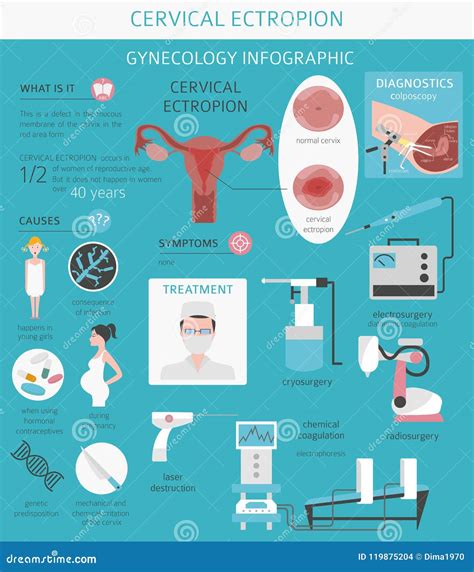 Cervical Ectropion. Ginecological Medical Desease Infographic Stock Vector - Illustration of ...