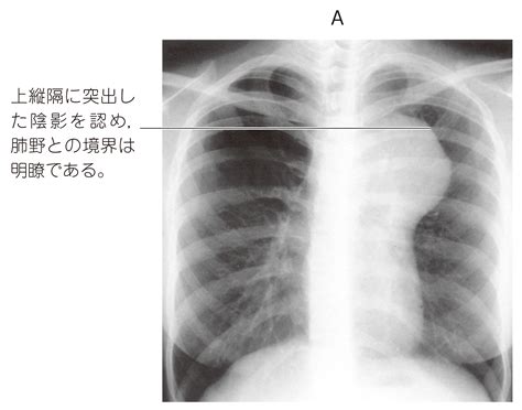 94e33 縦隔腫瘍 国試 M3e Medical