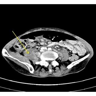 A Contrast Enhanced Axial CT Image Through Upper Pelvis Demonstrate