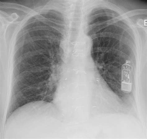 Implanted Cardiac Loop Recorder