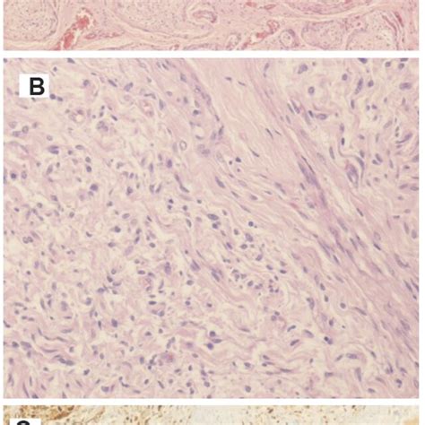 Photomicrograph Of The Plexiform Neurofibroma Histopathological Image Download Scientific