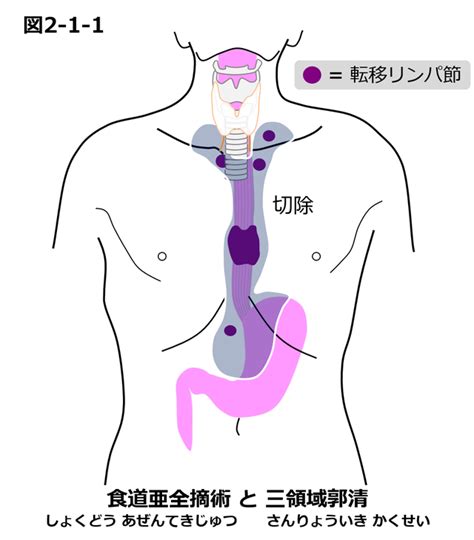 2⾷道がんの⼿術治療 国立がん研究センター 東病院