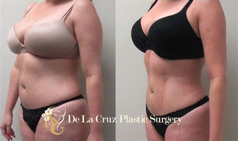 Liposuction Houston Can Supply People Alike With Broader And Much Better Body Proportions While