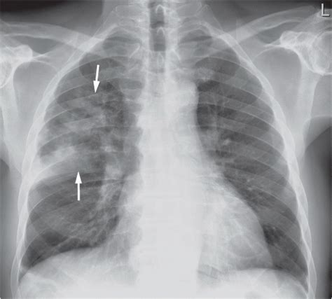 Pneumonia Radiology Key