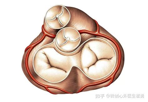 杭州治疗重度二尖瓣反流浙江省人民医院通过腋下心脏微创二尖瓣成形手术 知乎