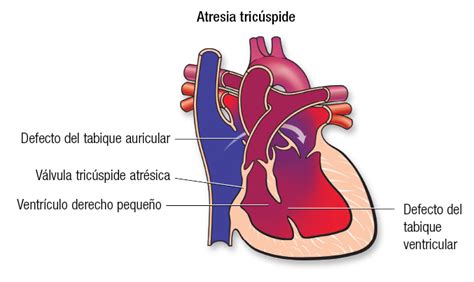 Atresia Tric Spide American Heart Association