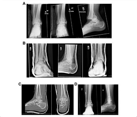 Trimalleolar Ankle Fracture Recovery