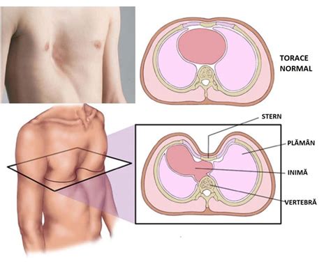 STERNUL ÎNFUNDAT ȘI RECUPEREAREA PRIN KINETOTERAPIE O CALE SPRE