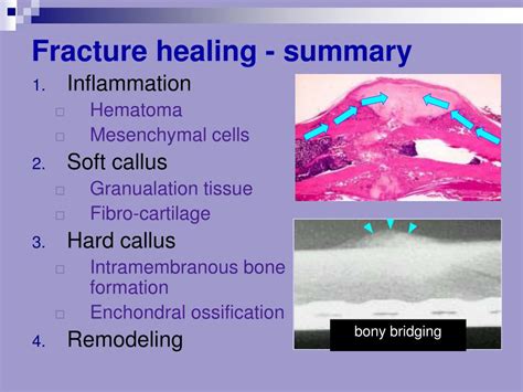 Ppt Bone Fracture And Healing Powerpoint Presentation Free Download