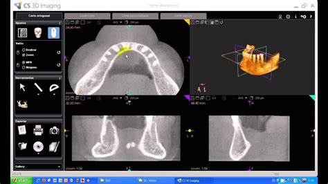 Tutorial Cs D Imaging Software Carestream Carestream Uso De La