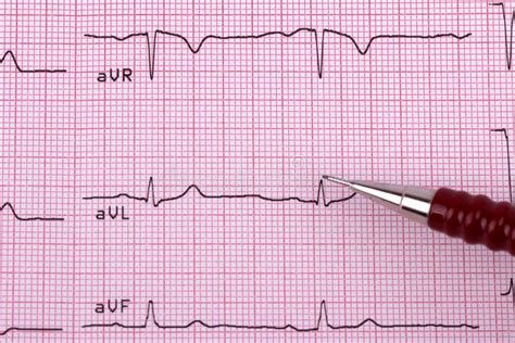 Healthy Heart Cardiogram Stock Illustration Illustration Of Pattern