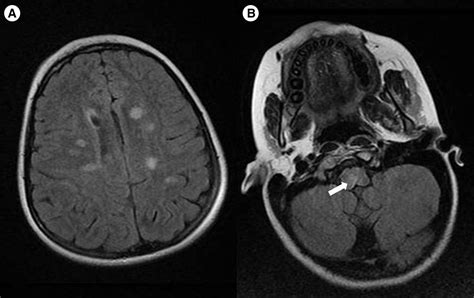 Pediatric Multiple Sclerosis Presenting As Area Postrema Syndrome