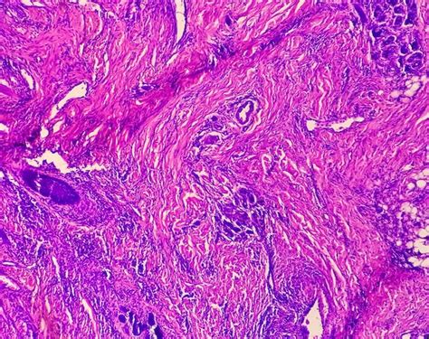 La Vista Microscópica Del Carcinoma Basocelular Es Un Tipo De Cáncer De