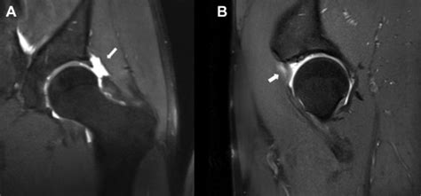 Arthroscopic Capsule Reconstruction In The Hip Using Iliotibial Band