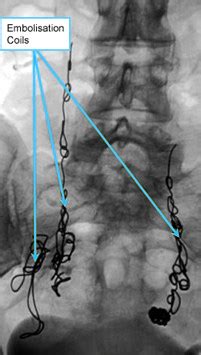 Pelvic Congestion Syndrome Symptoms Risks And Treatment Options