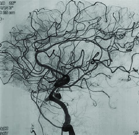 Lateral Four Vessel Cerebral DSA After Surpass Evolve FD Placement For