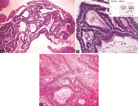 Antrochoanal Polyp Histology