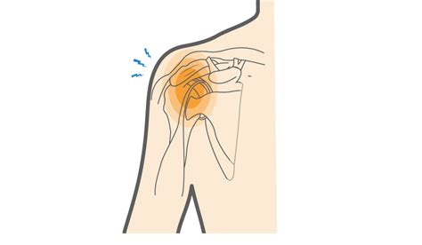 What Is Rotator Cuff Bursitis And How To Manage Shoulder Pain Upswing Health