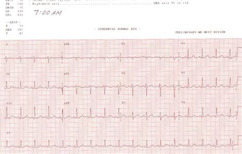 Clinical Cases And Images Cardiology Atrial Fibrillation Afib