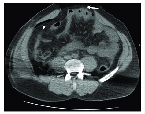 Corte axial de tomografía computarizada de abdomen en fase simple a