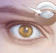 Cataract Eye Surgery In Delhi Health Nigeria