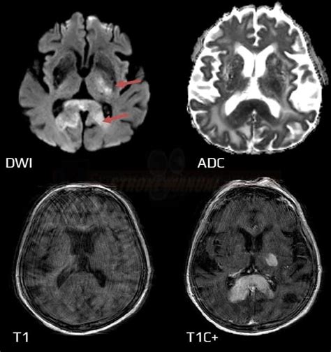 MR-DWI in the acute stroke diagnosis | STROKE MANUAL